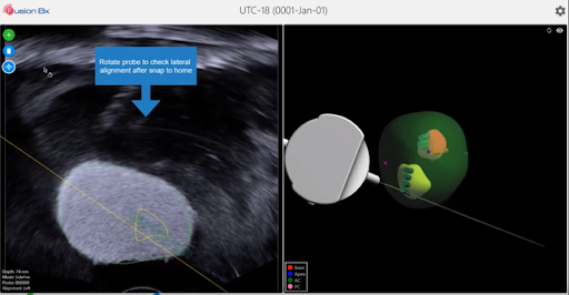 Lateral scan shows MRI is aligned with ultrasound