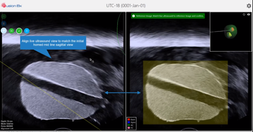 Probe is maneuvered until live ultrasound (left) matches “home” image (right)